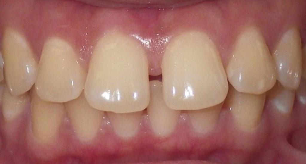 Spacing3TeethBefore Spacing3TeethBefore