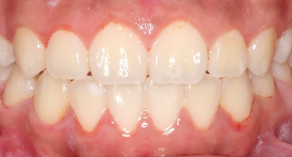 Underbite1TeethAfter Underbite1TeethAfter