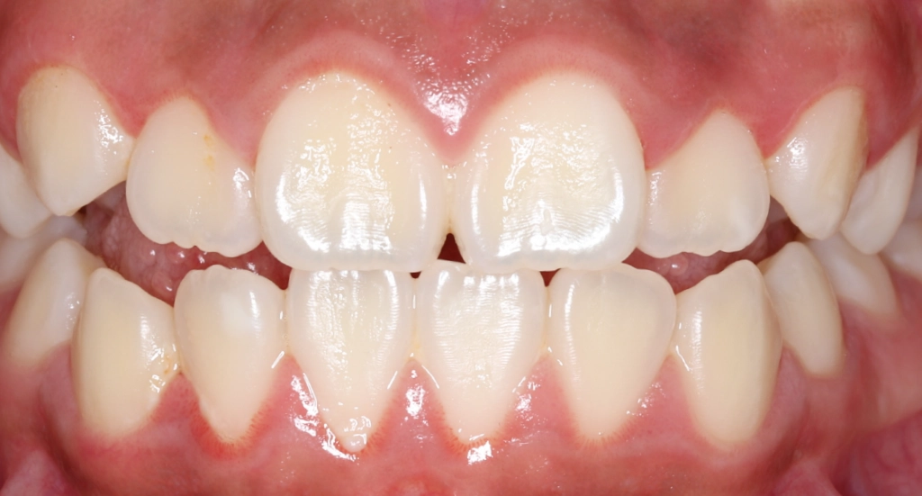 Underbite1TeethBefore Underbite1TeethBefore