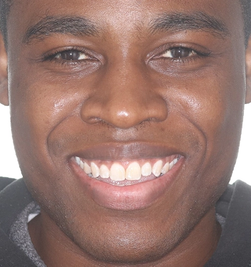 Underbite2Before Underbite2Before