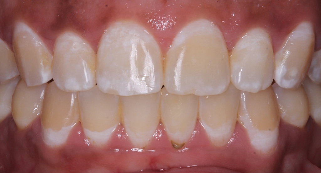 Underbite2TeethAfter Underbite2TeethAfter