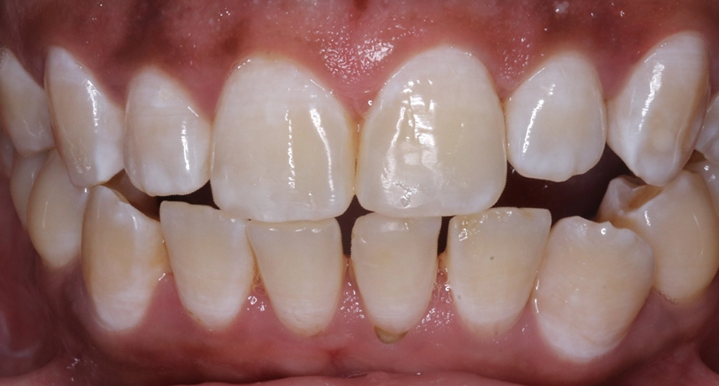 Underbite2TeethBefore Underbite2TeethBefore