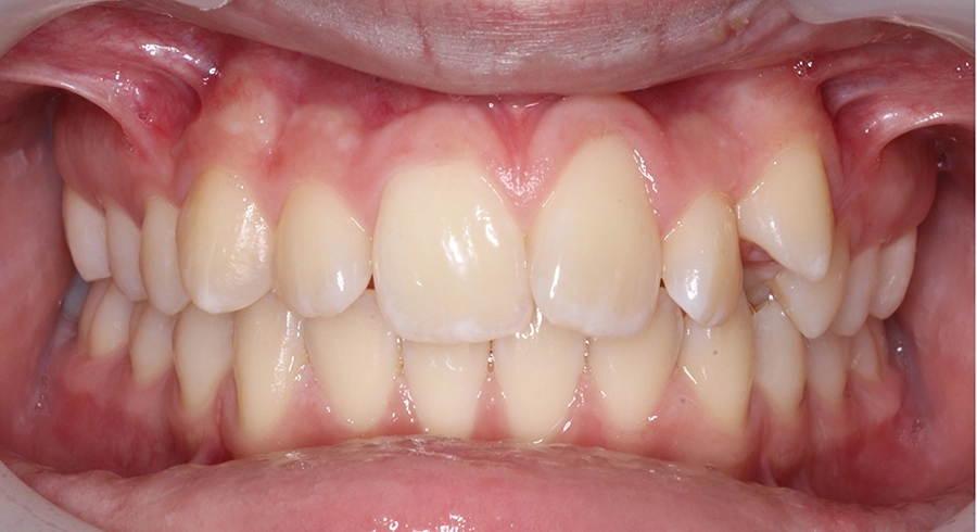 Joey O. Initial_Intraoral Center_00 Joey O. Initial Intraoral Center 00