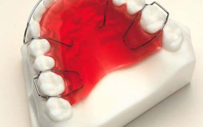 The Role of Retainers: Keeping Your Smile Straight for Life