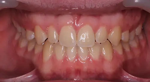 Underbite Patient 2 After 2