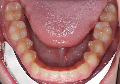 Underbite Patient 2 After 3