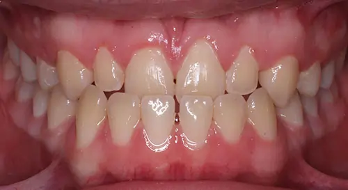 Underbite Patient 2 Before 2