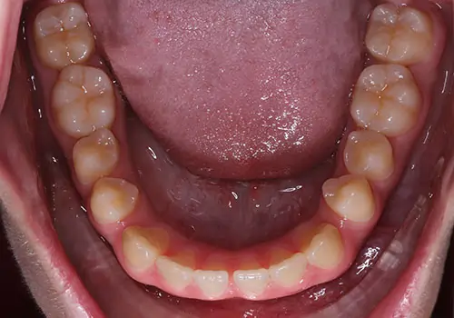 Underbite Patient 2 Before 3