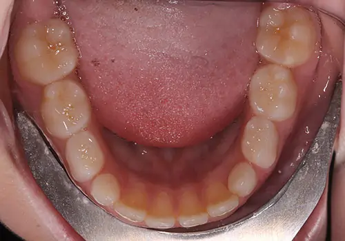 Phase 1 Patient 10 After 3