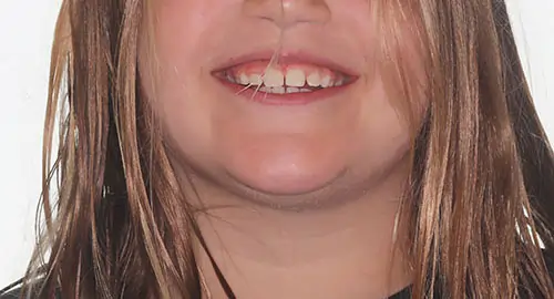 Phase 1 Patient 10 After 1