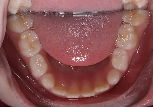 Phase 1 Patient 10 Before 3