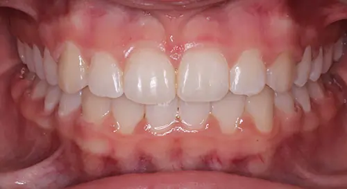 Crowding Patient 12 After 2