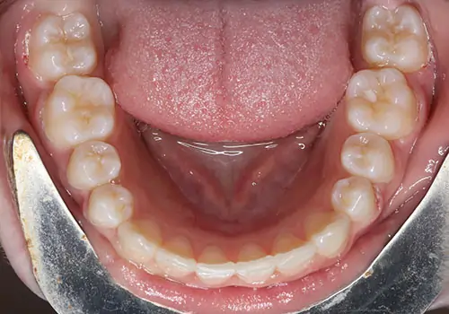 Crowding Patient 12 After 3