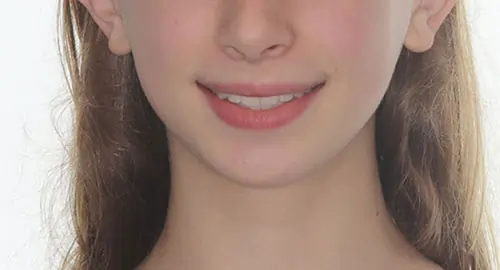 Crowding Patient 12 After 1