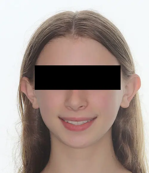 Crowding Patient 12 After 1