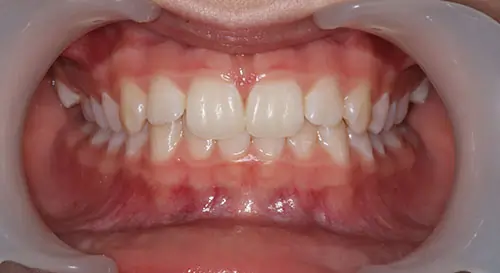 Crowding Patient 12 Before 2