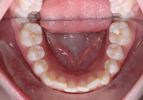 Crowding Patient 12 Before 3