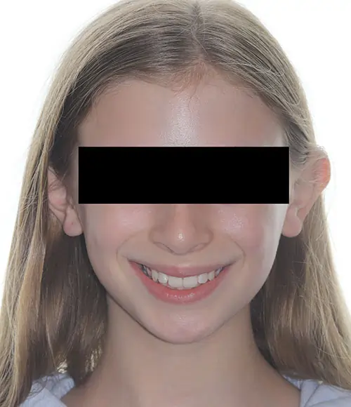 Crowding Patient 12 Before 1