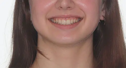 Invisalign Patient 8 After 1