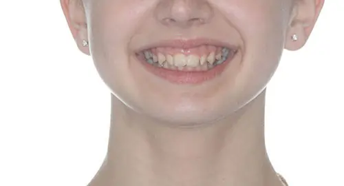 Invisalign Patient 8 Before 1