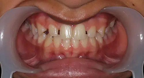 Spacing Patient 4 Before 2