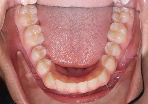 Spacing Patient 4 Before 3