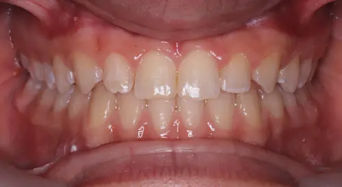 Spacing Patient 4 After 2