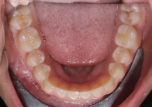 Spacing Patient 4 After 3