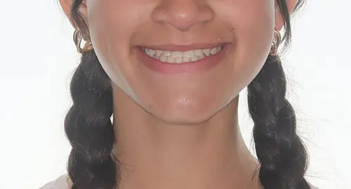 Spacing Patient 4 After 1