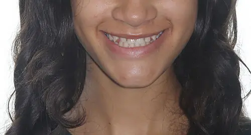 Spacing Patient 4 Before 1