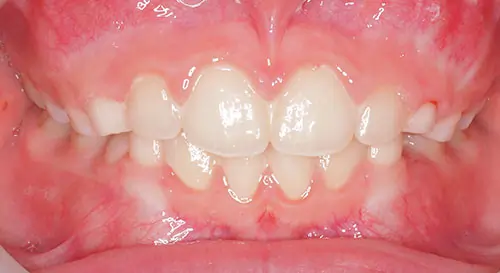 Phase 1 Patient 11 After 2