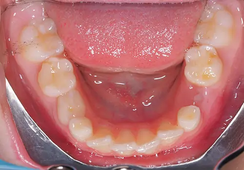 Phase 1 Patient 11 After 3