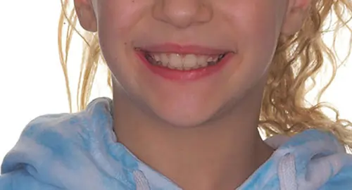 Phase 1 Patient 11 After 1