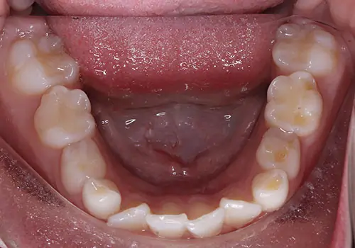 Phase 1 Patient 11 Before 3