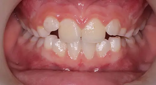 Phase 1 Patient 11 Before 2