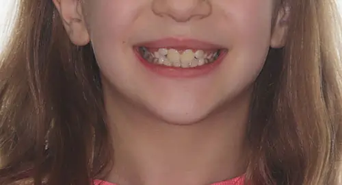 Phase 1 Patient 11 Before 1