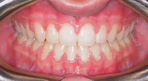 Underbite Patient 3 After 2