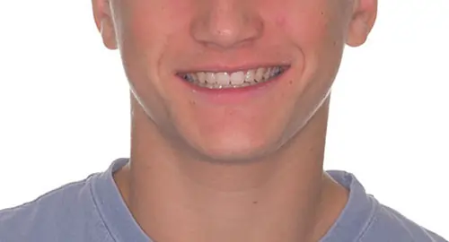 Underbite Patient 3 After 1