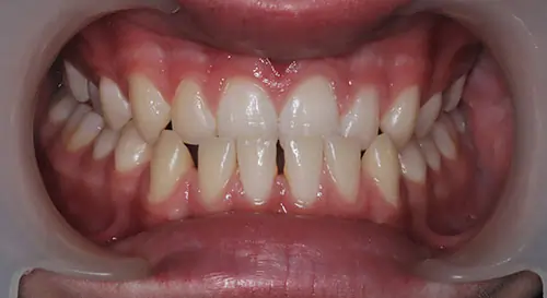 Underbite Patient 3 Before 2