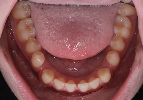 Underbite Patient 3 Before 3