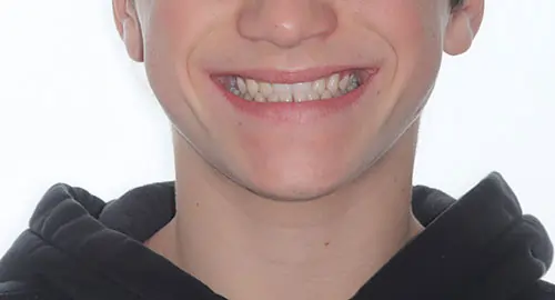 Underbite Patient 3 Before 1