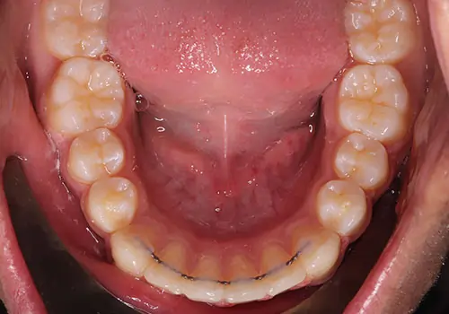Crowding Patient 13 After 3