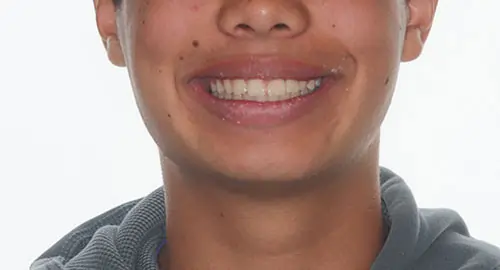 Crowding Patient 13 After 1