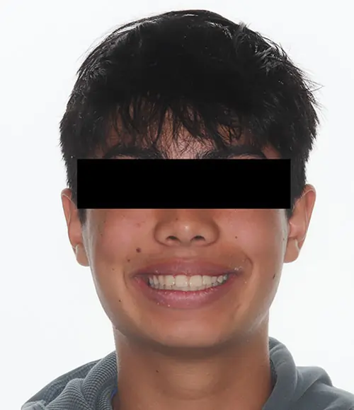 Crowding Patient 13 After 1