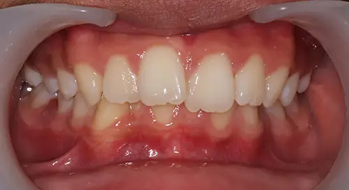 Crowding Patient 13 Before 2