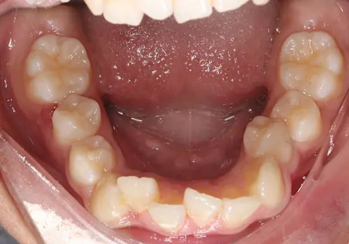 Crowding Patient 13 Before 3