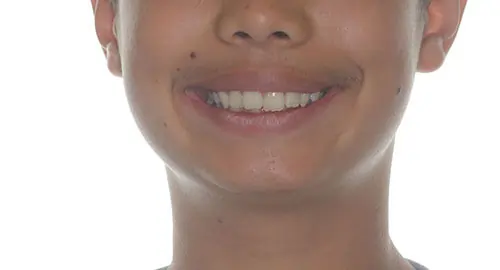 Crowding Patient 13 Before 1