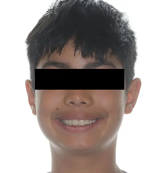 Crowding Patient 13 Before 1