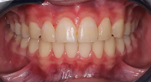 Overbite Patient 10 After 2