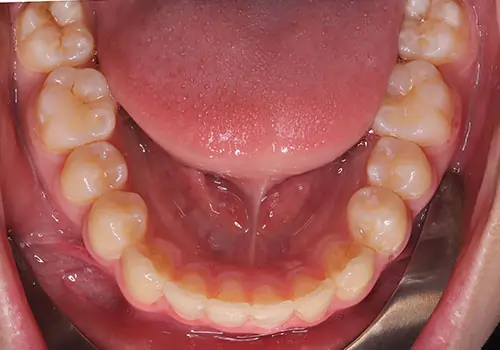Overbite Patient 10 After 3